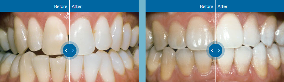 zoom teeth whitening downtown seattle dentist