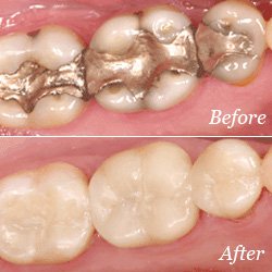 Dental crown treatment in Seattle